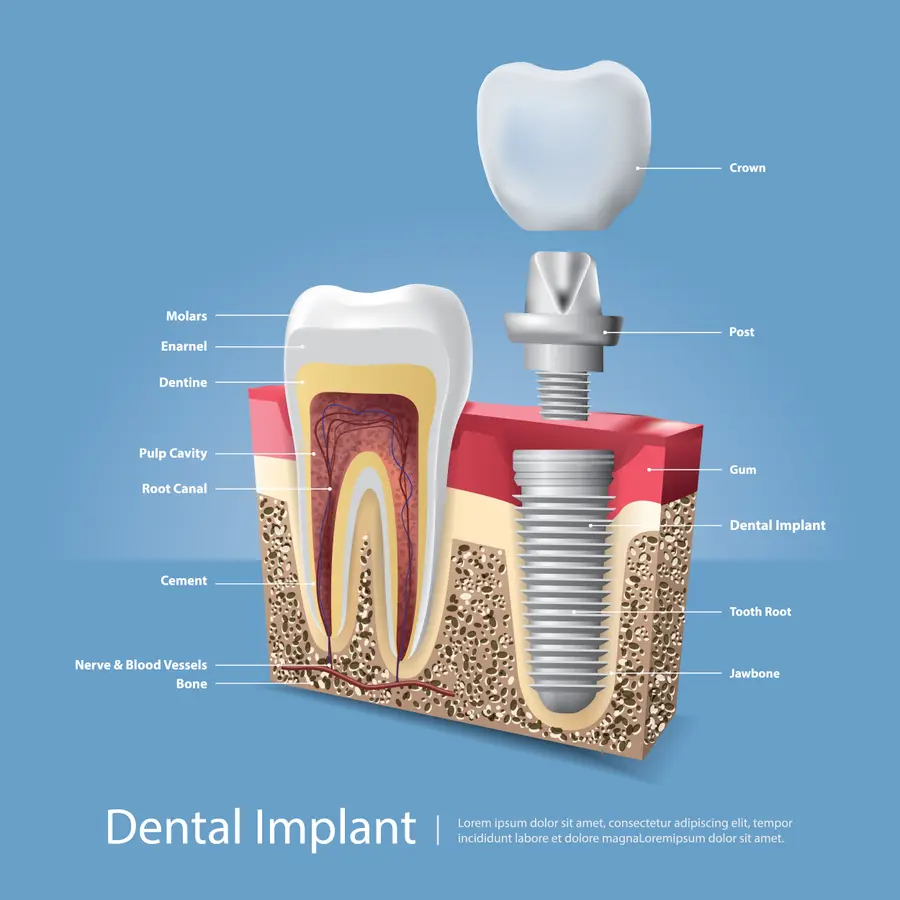 Infográfico ilustrando as partes de um implante dentário: coroa, pino, gengiva e osso.