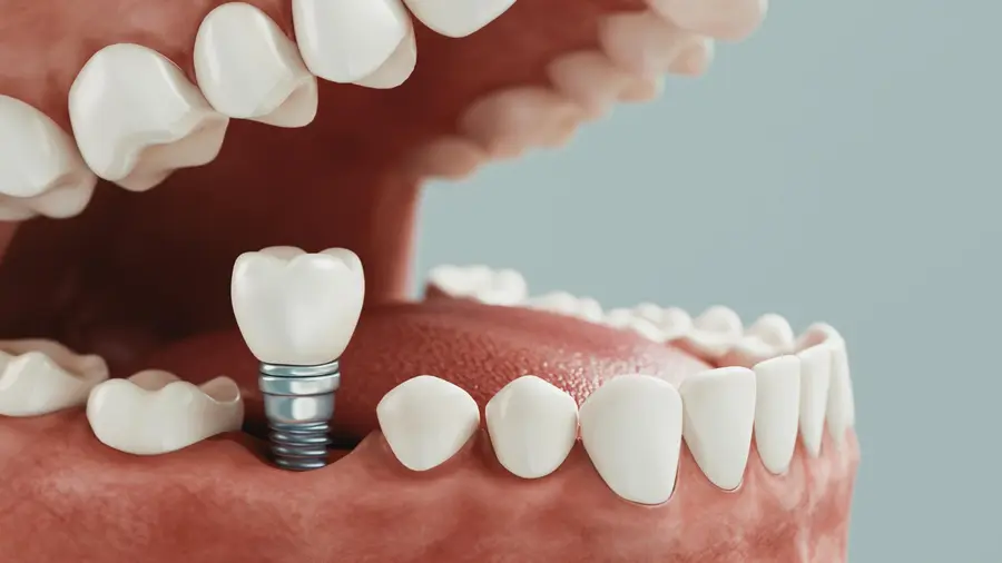 Representação em 3D de um implante dentário instalado entre os dentes naturais.