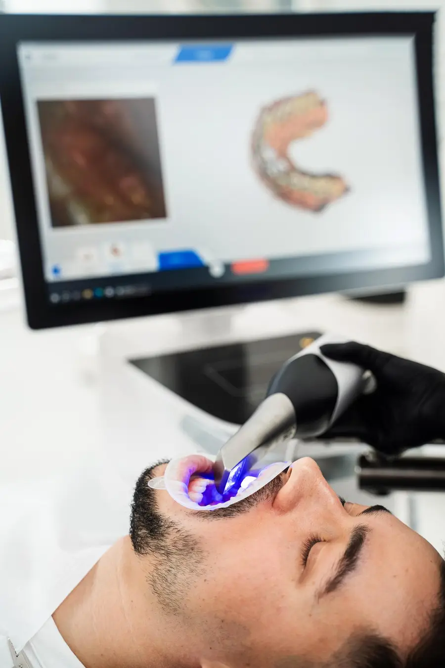 Paciente passando por escaneamento intraoral digital, com o modelo 3D do caso na tela.