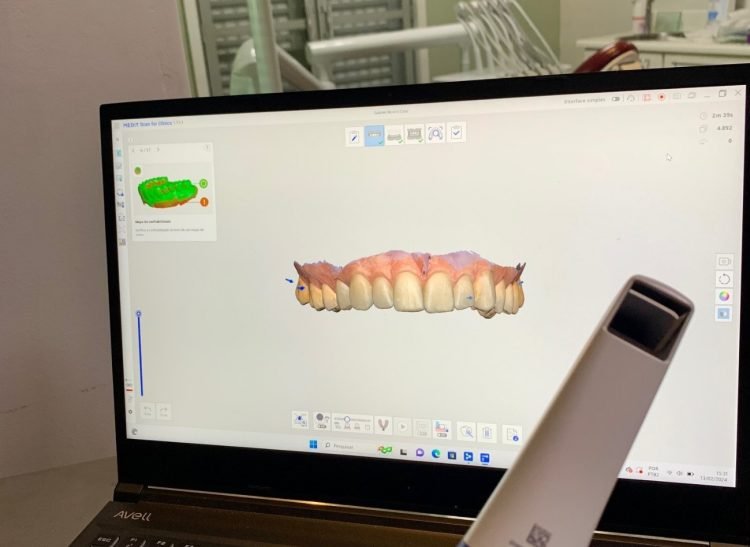 Escaneamento Intraoral 2 Riccoodonto